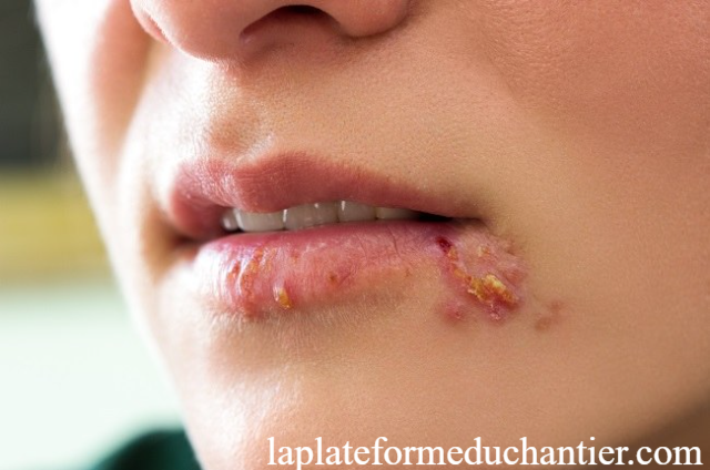 Kenali Gejala dari Penyakit Herpes