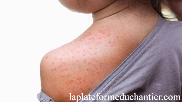 Yuk Kita Cari Tahu! Apa Saja Ciri dan Gejala Penyakit HIV?